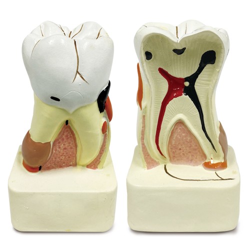 Mô hình sâu răng (kích thước lớn gấp 10 lần kích thước thật)